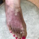 Leczone przypadki - poparzona stopy