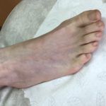 Przypadki leczone w CM Zwierzyniecka - poparzenie stopy